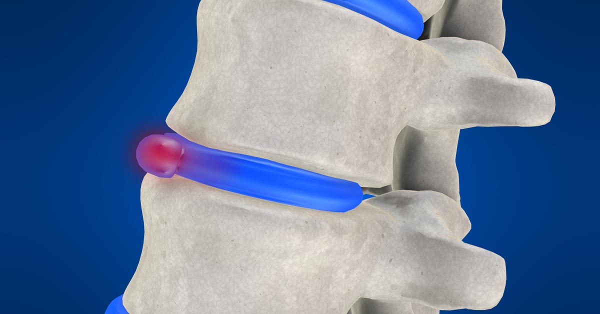 Napa, CA non-surgical disc herniation treatment